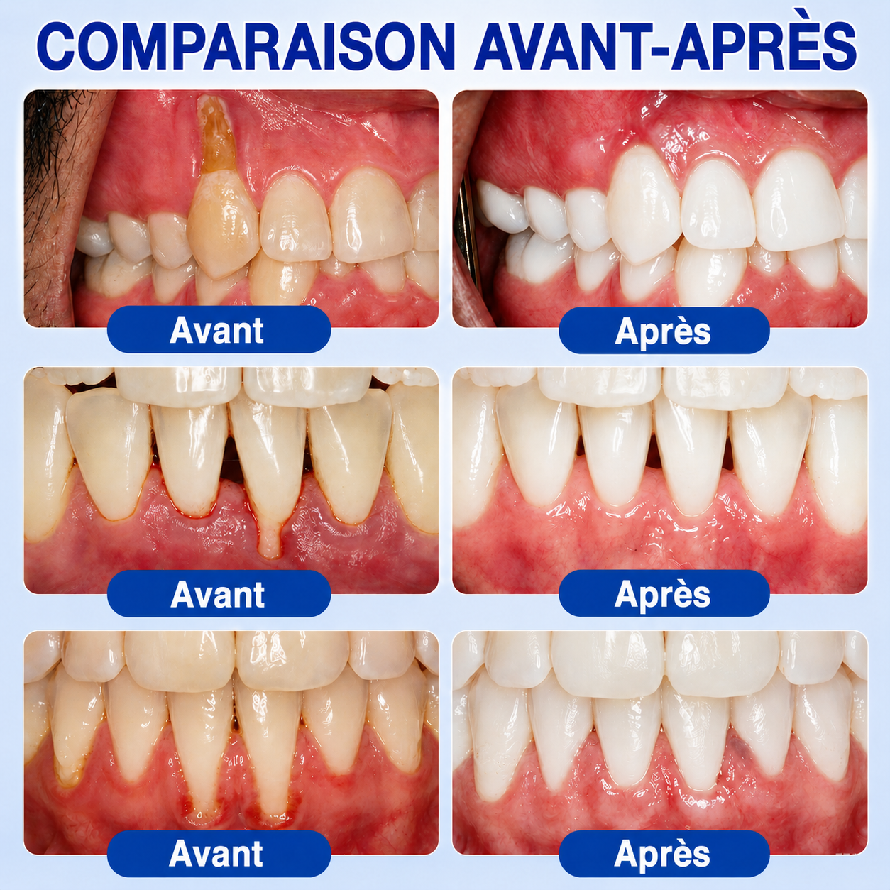 🇫🇷⚡GarageLine® GumRevive – Le Gel Avancé pour des Gencives Plus Saines et un Sourire Éclatant
